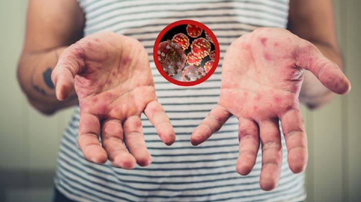 Aceleran combate contra sarampión en Nuevo Laredo; ¿cuándo y dónde es la campaña de vacunación?