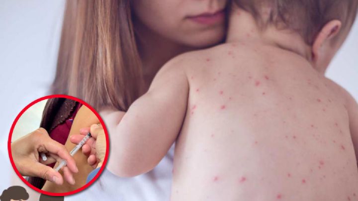 ¿Tuviste sarampión de niño?; las pruebas médicas que revelan si tienes inmunidad