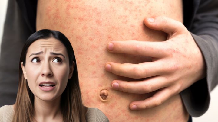 Nuevo León alcanza 36 casos confirmados de sarampión en 2026; Salud reporta 674 pacientes probables