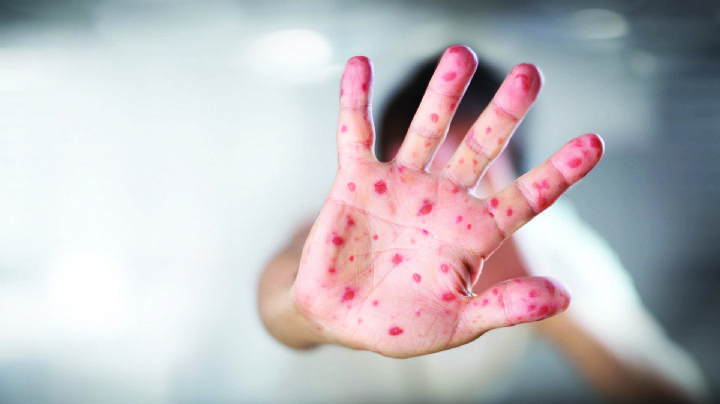 Sarampión: estos nueve estados de EU presentan más casos de contagios