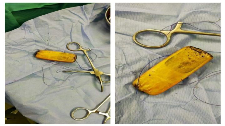 Hombre vivió con un celular en su estómago ¡por siete meses!