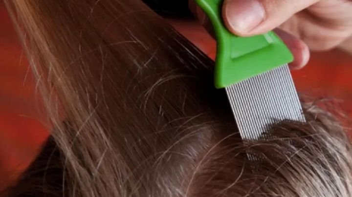 VIDEO VIRAL: Cabeza de niña se infesta con más de 15 mil piojos