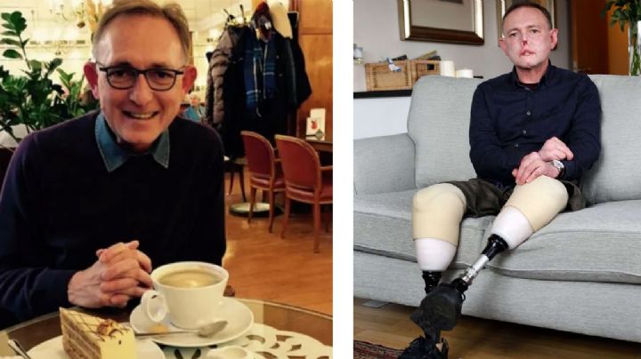 Médico pierde parte de la cara, piernas y dedo por una lamida de su perro