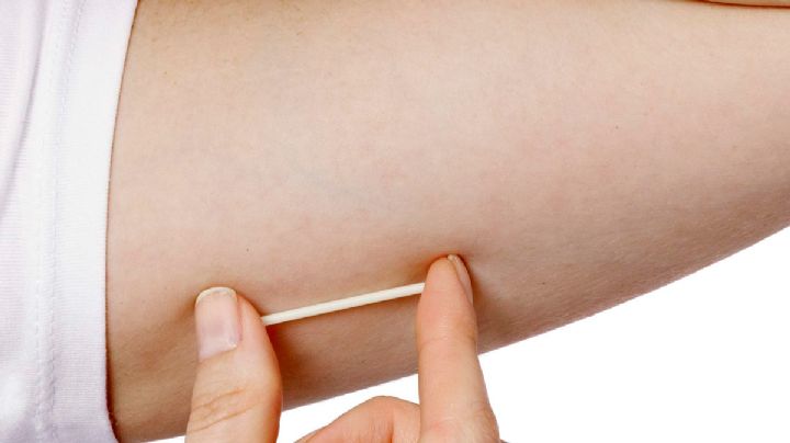 ¿Engordaste con el implante subdérmico?  Todo lo que tienes que saber sobre sus efectos secundarios