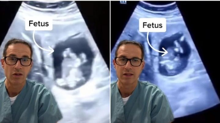 Extraño embarazo: Médico documenta feto creciendo en hígado de su mamá