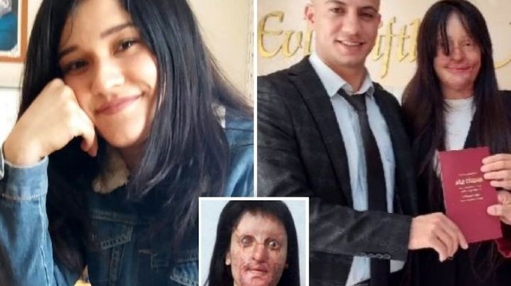Hombre le arrojó ácido a la cara de su amada; lo perdona y se casan