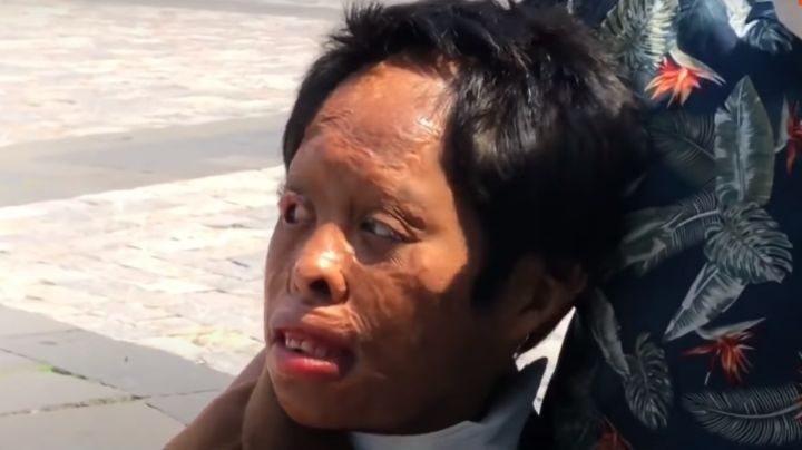 "Me vendió mi papá" y también la quemó: el brutal abuso físico que sufrió una niña en Guerrero