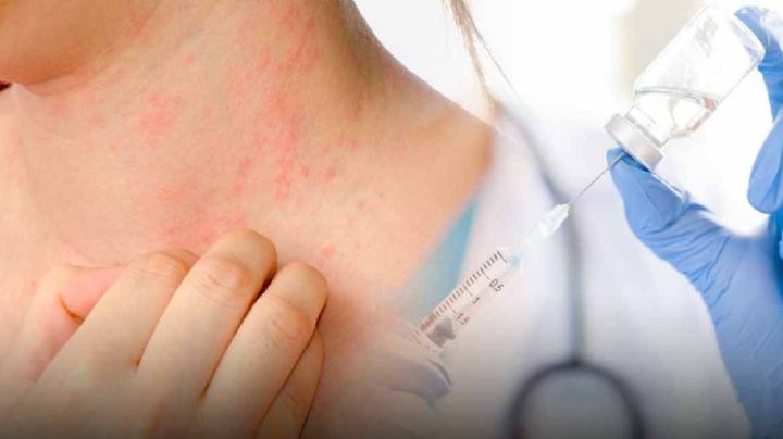 Vacuna coronavirus: Alergias no son impedimento para ir a vacunarse