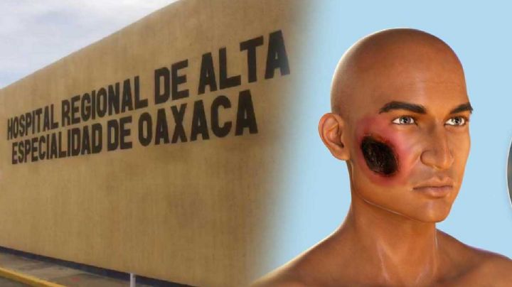 Hongo Negro México: Reportan dos casos en pacientes que sufrieron Covid-19