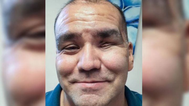 Sobreviviente mexicano al hongo negro: "Me despertaba llorando del dolor"