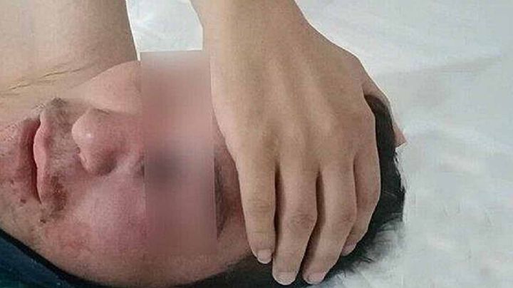 Murió Gregorio, primer paciente con hongo negro en México