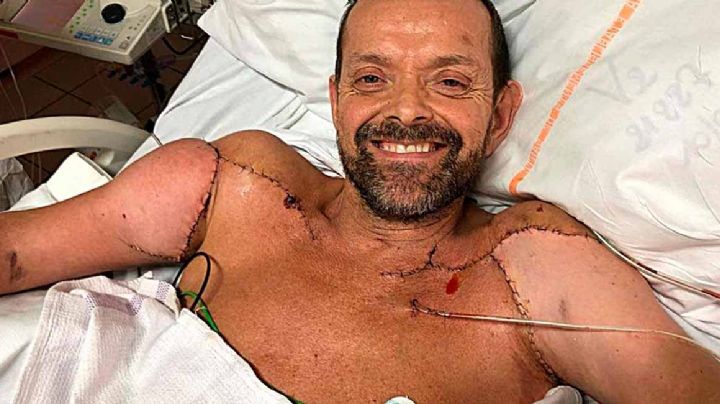 VIDEO: Hombre que recibe TRASPLANTE DE BRAZOS ya puede moverlos