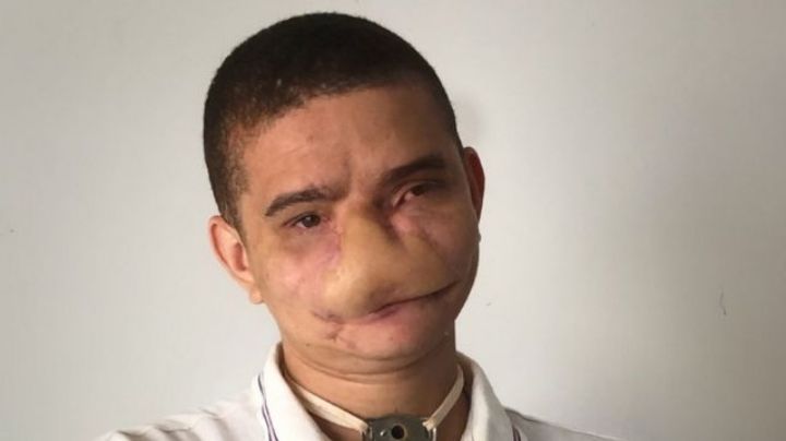 Samuel Rodrigues, el joven que le explotó un cohete en el rostro