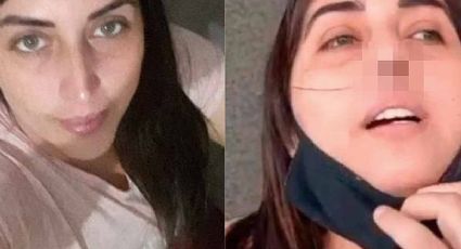 Mujer requiere cirugía de nariz tras prueba PCR de covid mal practicada