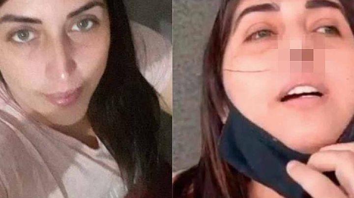 Mujer requiere cirugía de nariz tras prueba PCR de covid mal practicada