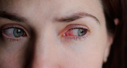 Conjuntivitis síntoma del Covid común en variante Ómicron