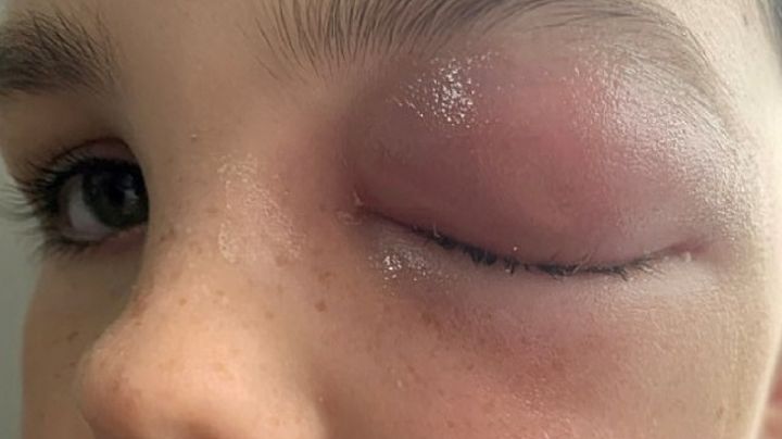 Menor de edad casi pierde vista por infección relacionada a la covid-19