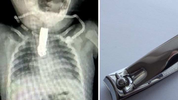 Bebé se tragó un cortauñas y es llevado al hospital de emergencia