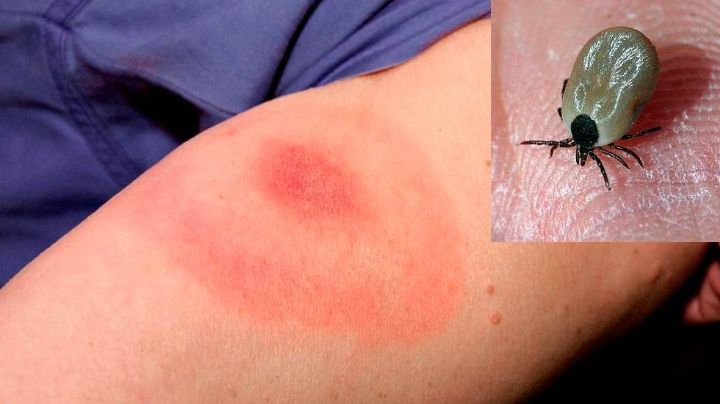 Muere niña por mordedura de garrapata en Nuevo León