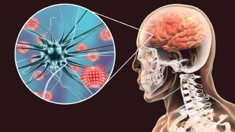 La meningitis puede producir síntomas parecidos a la influenza, causando la mayoría de las muertes en las mujeres contagiadas