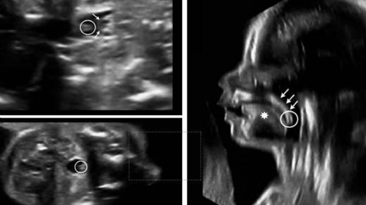 Ligan caso de paladar hendido a contaminación en Nuevo León