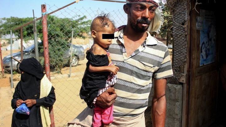 Niña de 3 años y con 4 kilos de peso simboliza casos de desnutrición que golpean a Yemen