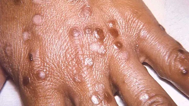 Surge caso sospechoso de viruela del mono en Nuevo Laredo