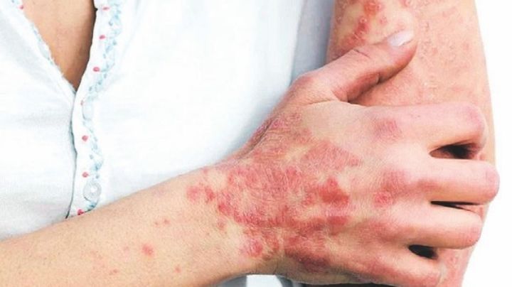 Descartan viruela símica en Nuevo Laredo