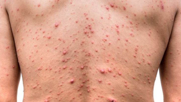OMS reporta más de 5 mil casos de viruela del mono en el mundo