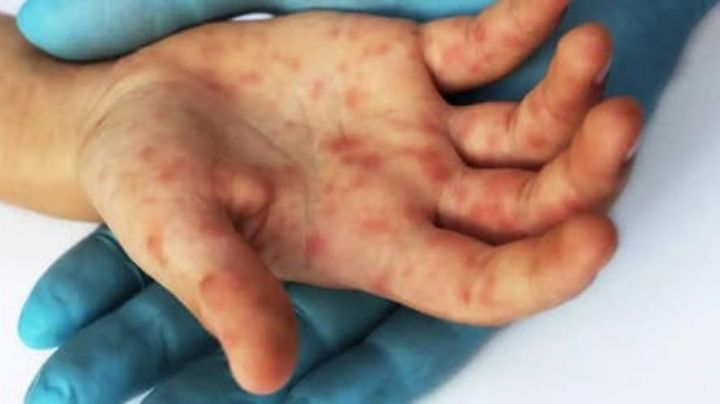 Autoridades investigan posible caso de viruela del mono en menor de Tamaulipas