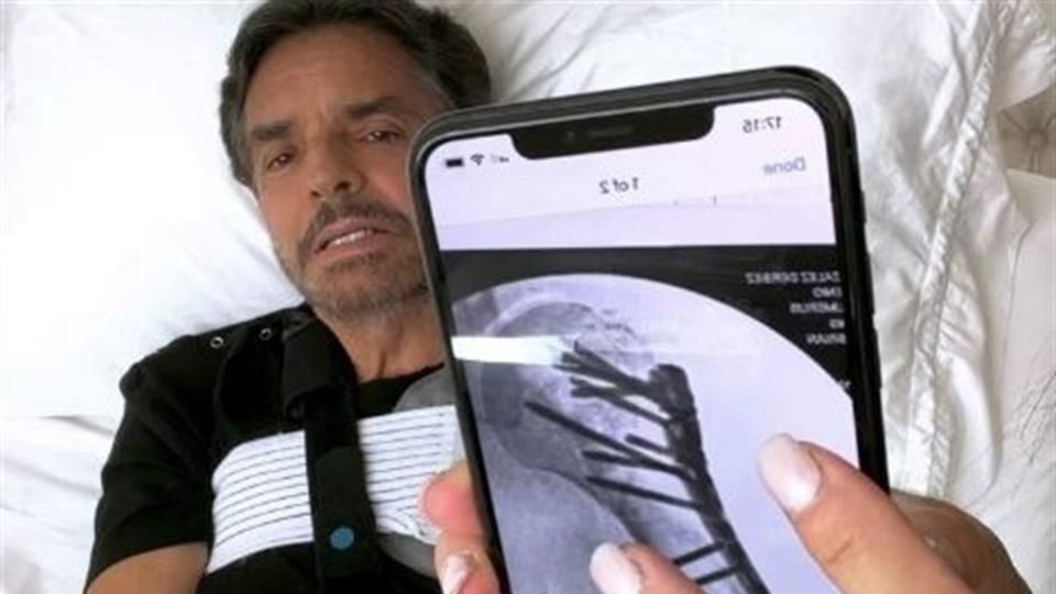 Eugenio Derbez reveló que se la ha pasado sedado por dos semanas tras sufrir un accidente