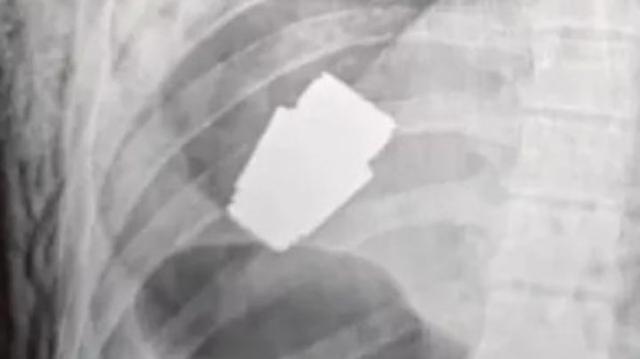 Extraen una granada alojada en el pecho a soldado ucraniano; vive de milagro