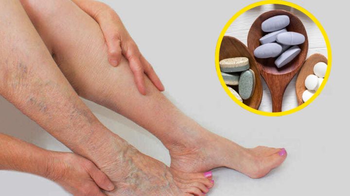 Várices: evítalas con estas 4 vitaminas y estos ejercicios
