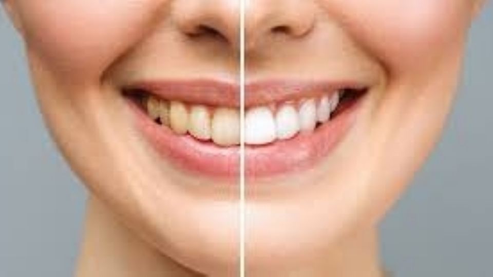 La Asociación Dental Americana recomienda algo muy sencillo para quitar las manchas de la dentadura