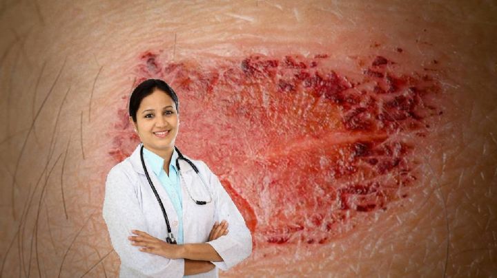 Razón por la que no debes rascarte o quitarte la costra de herida