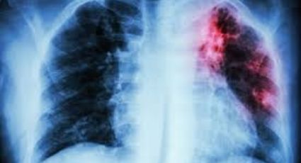 Tuberculosis mata a dos personas en Nuevo Laredo