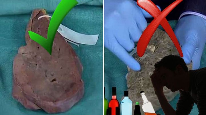 La cirrosis podría matarte; tal vez ya está en tu cuerpo