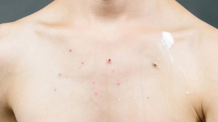 MPOX: ¿Qué es y cómo se contagia esta enfermedad? Van 5 muertos en México