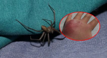 Araña violinista pica a niño en Reynosa; jugaba bajo la cama