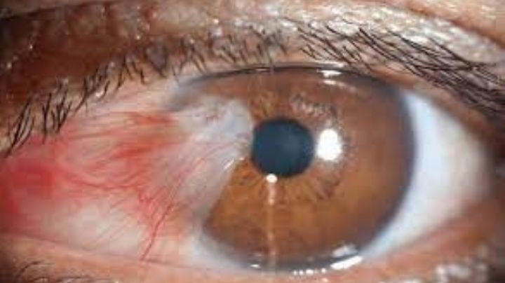 Campaña gratuita de cirugía ocular en Nuevo Laredo; estos son los requisitos