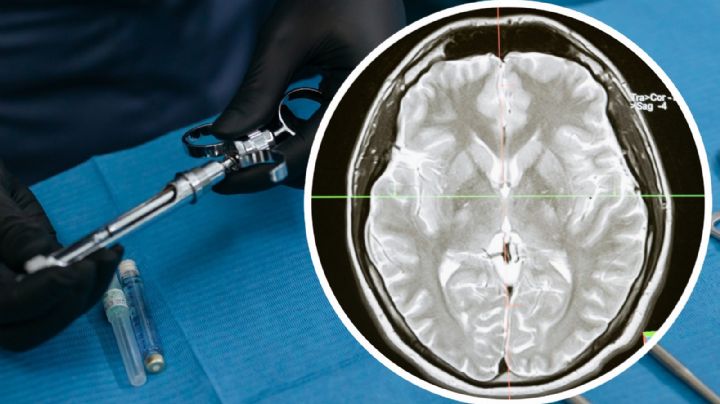 Alertan CDC de EU por casos de meningitis en Tamaulipas; ¿qué es y cómo ocurre?