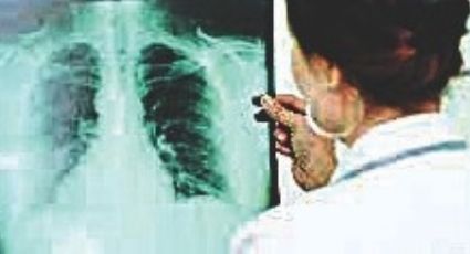 Aumentan casos de tuberculosis