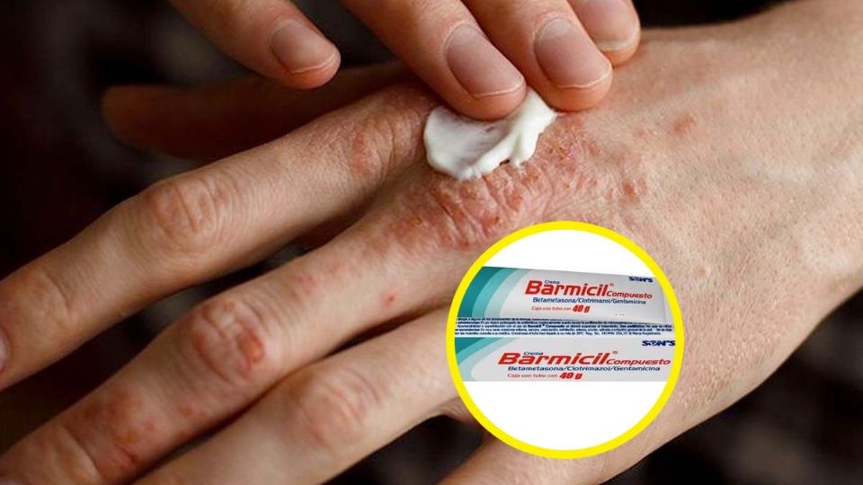 El uso de la crema sin ser recomendada por un doctor podría dañar la salud