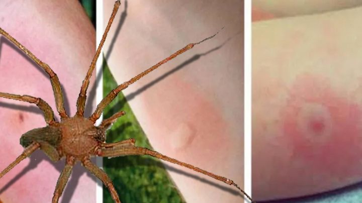 Araña violinista: primeros auxilios en caso de una picadura; solo cuentas con pocos minutos