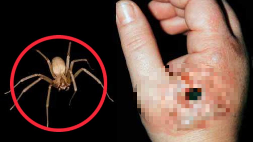 Aquí podrás conocer las características de la picadura de esta araña, para que no vayas a confundir la mordedura de otro bicho