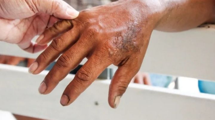 Alertan por casos de lepra en 12 municipios del país; contagios van al alza