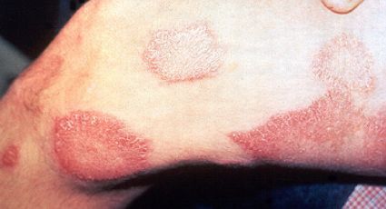 ¿Cómo se contagia la lepra y cuáles son sus síntomas?