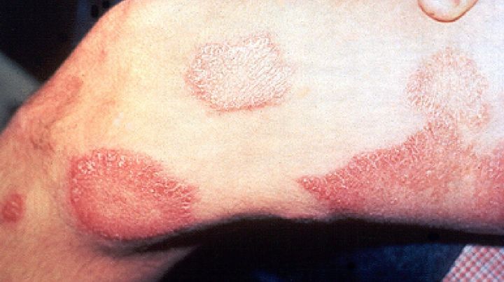 ¿Cómo se contagia la lepra y cuáles son sus síntomas?