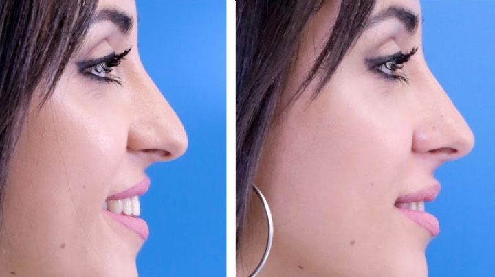 ¿Cómo levantarte la punta de la nariz sin cirugía?; resultados sorprendentes
