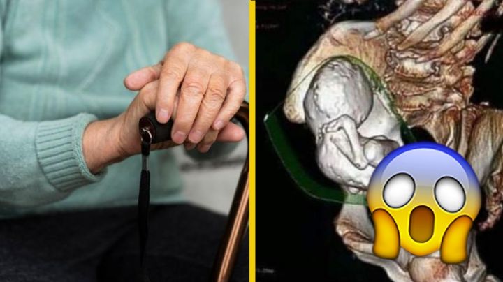 Mujer acude al IMSS y le detectan feto momificado por 40 años | FOTO